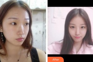 安徽醫(yī)科大學(xué)附屬阜陽(yáng)醫(yī)院燒傷整形創(chuàng)面外科白永強(qiáng)整形價(jià)格表附祛疤案例展示