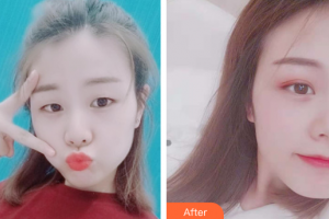 廣州美詩(shī)沁醫(yī)療美容門診部徐文奎整形價(jià)格表附雙眼皮案例展示