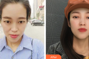 廣州利美康粵美門診部孫峰整形價(jià)格表附眼部整形案例展示