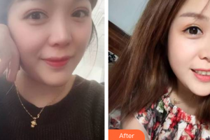 廣州拜博醫(yī)療美容門診部李正衍整形價(jià)格表附牙齒隱形矯正案例展示