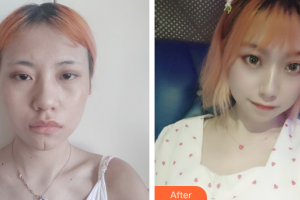 廣州博研醫(yī)療美容門診部陳勇軍整形價(jià)格表附凹陷疤痕案例展示