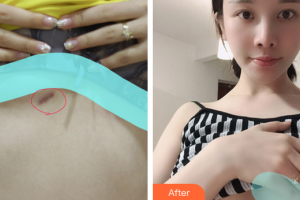 廣州博研醫(yī)療美容門診部劉鳳巖整形價(jià)格表附激光祛疤痕案例展示