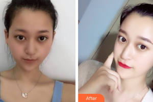 廣州弘基醫(yī)療美容門診部崔浩鉉整形價(jià)格表附顴骨降低案例展示