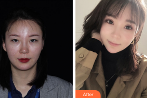 民航廣州醫(yī)院整形美容科陳小光整形價(jià)格表附眼部綜合案例展示