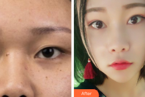 廣州美詩(shī)沁醫(yī)療美容門診部宣瑞軍整形價(jià)格表附眼部手術(shù)案例展示