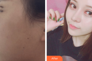 廣州軍區(qū)總醫(yī)院全軍激光整形美容中心程飚整形價(jià)格表附雙眼皮案例展示