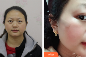 廣州博研醫(yī)療美容門診部田艷麗整形價(jià)格表附面部疤痕修復(fù)案例展示