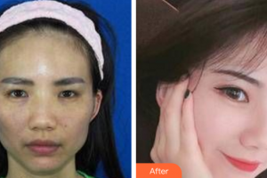 廣州洛萱醫(yī)療美容門診部彭章松整形價(jià)格表附自體脂肪全臉填充案例展示