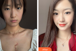 廣州柏德口腔門診部薛啟明整形價格表附增生疤痕案例展示