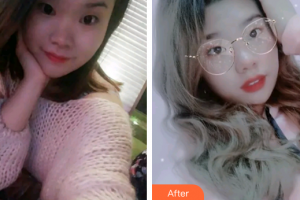 廣州德倫口腔門診部倪靜娥整形價(jià)格表附牙齒隱形矯正案例展示