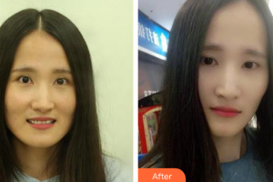 廣州德倫口腔門診部葉俊整形價(jià)格表附瓷貼面案例展示