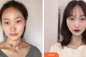 廣州膚康皮膚科醫(yī)院田華整形價(jià)格表附疤痕案例展示