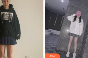 廣州勝康醫(yī)院醫(yī)療美容科趙辨整形價(jià)格表附縫針疤痕案例展示