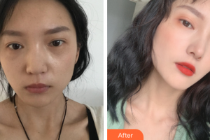 廣州艾美醫(yī)療美容門診部姬付康整形價(jià)格表附鼻部整形案例展示