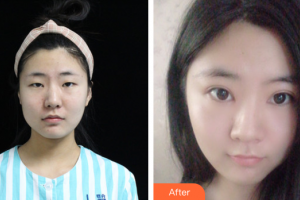 廣州雅度醫(yī)療美容醫(yī)院鄒順祿整形價(jià)格表附全切雙眼皮案例展示