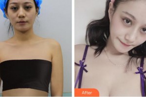 合肥恒美整形醫(yī)院孫楓整形價(jià)格表附假體隆胸棉花糖豐胸案例展示