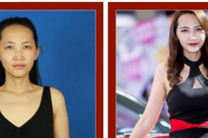 合肥恒美整形醫(yī)院錢(qián)毅整形價(jià)格表附假體隆胸案例展示