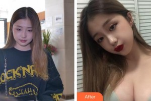 合肥恒美整形醫(yī)院王廣亮整形價(jià)格表附假體隆胸案例展示