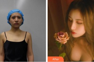 合肥恒美整形醫(yī)院李曉東整形價(jià)格表附脂肪填充胸部案例展示