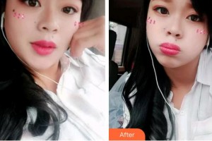 合肥華美整形美容醫(yī)院支梅整形價(jià)格表附牙齒隱形矯正案例展示