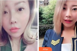 合肥愛(ài)春整形美容醫(yī)院范愛(ài)春整形價(jià)格表附牙齒隱形矯正案例展示