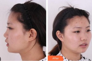 合肥申誠整形美容醫(yī)院程淦整形價(jià)格表附鼻部綜合案例展示