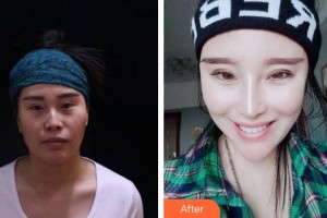 合肥博士整形外科醫(yī)院汪洪源整形價(jià)格表附隆鼻案例展示