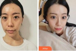 合肥第一人民醫(yī)院整形美容分院左宗寶整形價(jià)格表附埋線提升案例展示