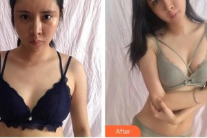 合肥龐博整形美容醫(yī)院龐良霞整形價(jià)格表附自體脂肪隆胸案例展示