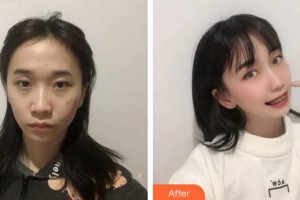 合肥龐博整形美容醫(yī)院李學(xué)恕整形價(jià)格表附疤痕案例展示