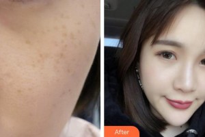 合肥現(xiàn)代婦科醫(yī)院整形美容中心陸玉定整形價(jià)格表附激光美膚祛斑案例展示