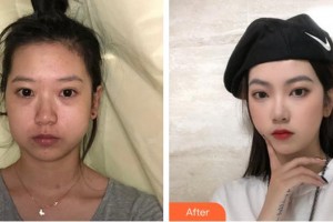 合肥龐博整形美容醫(yī)院白承銀整形價(jià)格表附下頜角磨骨案例展示