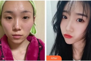 合肥大韓整形美容醫(yī)院衛(wèi)愛(ài)俠整形價(jià)格表附顴骨內(nèi)推案例展示