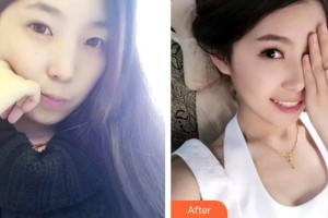 合肥大韓整形美容醫(yī)院劉喻平整形價(jià)格表附牙齒隱形矯正案例展示