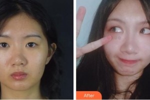 合肥愛(ài)春整形美容醫(yī)院傅賢德整形價(jià)格表附切開(kāi)雙眼皮案例展示
