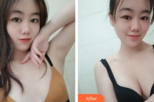 合肥丹鳳朝陽(yáng)婦科醫(yī)院整形美容外科周蔚整形價(jià)格表附自體脂肪隆胸案例展示