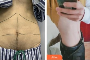 合肥丹鳳朝陽婦科醫(yī)院整形美容外科李長富整形價(jià)格表附腰腹吸脂案例展示