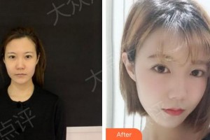 合肥壹加壹整形美容醫(yī)院余東整形價(jià)格表附熱瑪吉案例展示