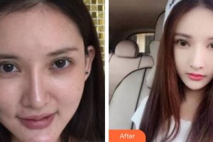 合肥壹加壹整形美容醫(yī)院蘇聖珉整形價(jià)格表附埋線提升案例展示