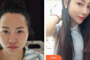 合肥凱美醫(yī)療美容醫(yī)院李立國整形價(jià)格表附肋軟骨隆鼻案例展示