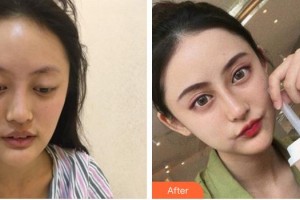 合肥亞典整形美容醫(yī)院陳超群整形價(jià)格表附鼻部綜合案例展示