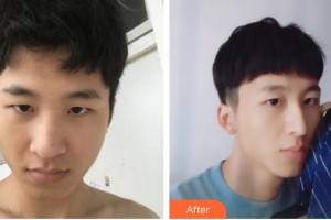 合肥亞典整形美容醫(yī)院徐家明整形價(jià)格表附隆鼻案例展示