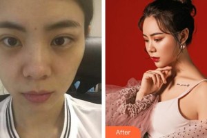 合肥崔勁松醫(yī)療美容診所石良兵整形價(jià)格表附雙眼皮修復(fù)案例展示