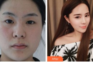 合肥臺美醫(yī)療美容門診部莊堅(jiān)文整形價(jià)格表附雙眼皮案例展示