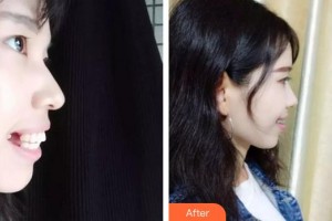 合肥童顏堂醫(yī)療美容醫(yī)院王璐瑜整形價(jià)格表附牙齒矯正案例展示