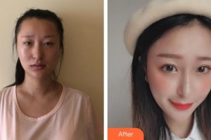 合肥童顏堂醫(yī)療美容醫(yī)院劉永飛整形價(jià)格表附埋線提升案例展示