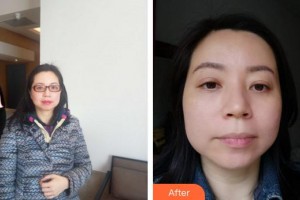 合肥童顏堂醫(yī)療美容醫(yī)院曾麗燕整形價(jià)格表附埋線提升案例展示