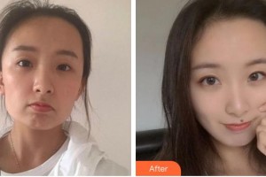 合肥臺美醫(yī)療美容門診部羅世恩整形價(jià)格表附埋線提升案例展示