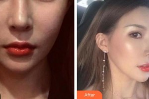 合肥光美醫(yī)療整形美容醫(yī)院尹芳整形價(jià)格表附熱瑪吉案例展示