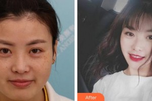 合肥光美醫(yī)療整形美容醫(yī)院田莉整形價(jià)格表附激光美膚激光案例展示